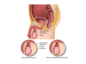 Diagram of how a vasectomy works