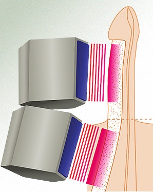 An illustration showing a penis with waves going through it, representing a treatment called  Linear shockwave therapy.