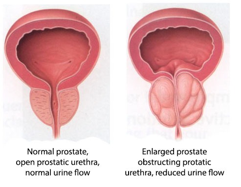 prostate-enlargement