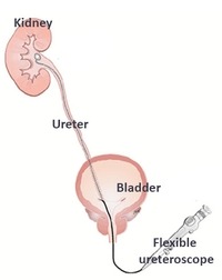 A flexible tube navigates through the bladder to the upper urinary tract, enabling access to a kidney stone for fragmentation or removal.