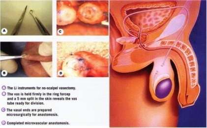 vasectomy-procedure-katelaris-urology2