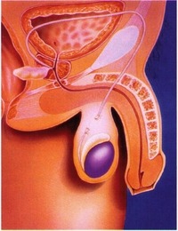 vasectomy1