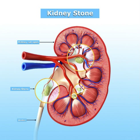 Katelaris_1_Sept_KidneyStones