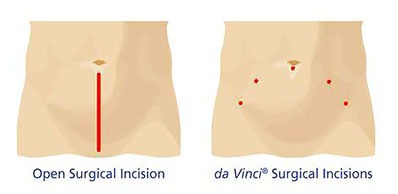 robotic prostate surgery incisions