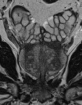 MRI-of-prostate-gland-01