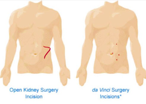 Incisions for robotic kidney surgery
