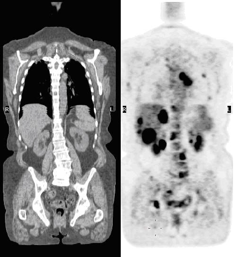 Targeting prostate-specific cell markers allows detection of prostate can-cer cells on PET-CT scanning.