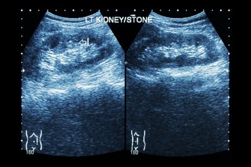 Ultrasonography of kidney