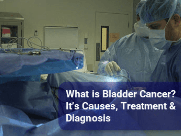 Causes and Treatment of Bladder Cancer