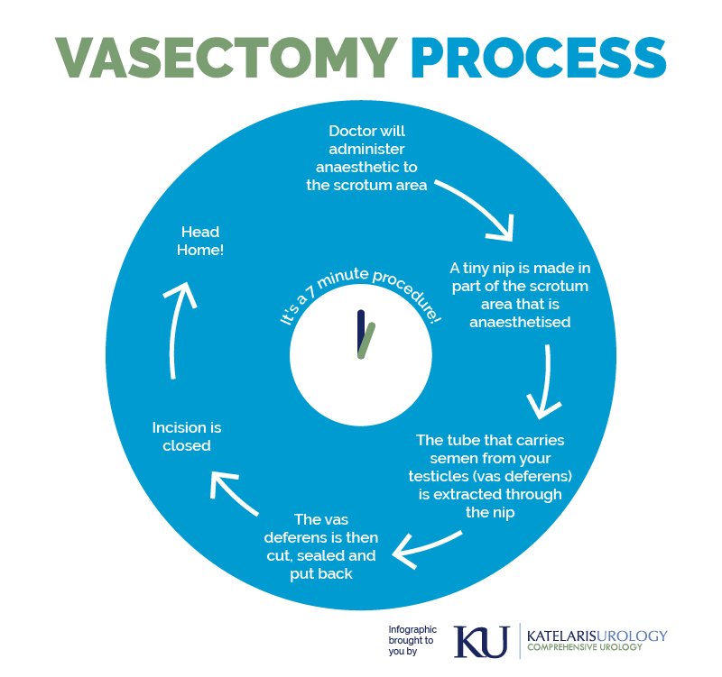 Vasectomy process infographic