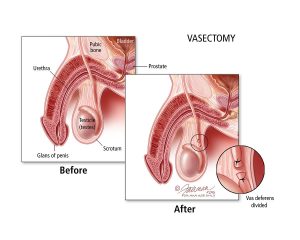 Anatomical comparison of a penis before and after a vasectomy procedure, with the 'before' illustration on the left showing an intact vas deferens, and the 'after' illustration on the right highlighting the vas deferens cut and sealed