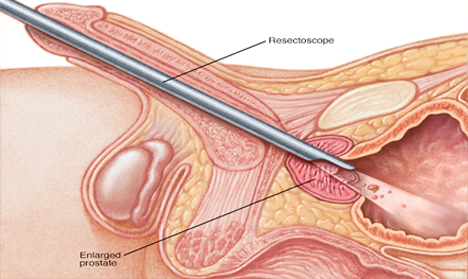 UroLift Or TURP - Which Procedure to Choose for Treating BPH? 2 TURP