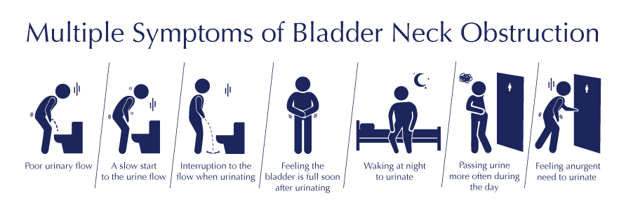 Multiple Symptoms of Bladder Neck Obstruction