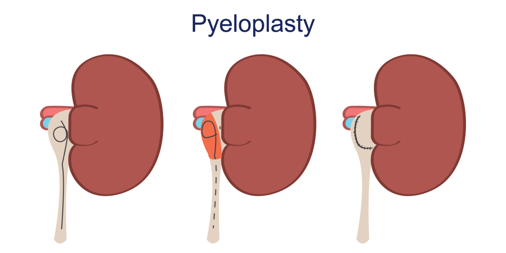 Pyeloplasty