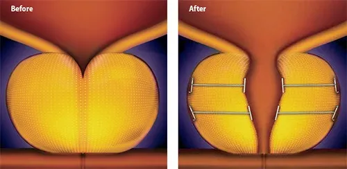 Prostate illustration, before and after the treatment 2, Dr Katelaris Sydney & North Shore
